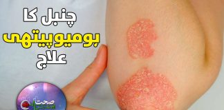 Psoriasis – Diagnosis and Treatment | Sehat Aur Tandrusti | 18th November 2023 | Kay2 TV